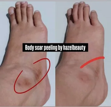 Body Treatment