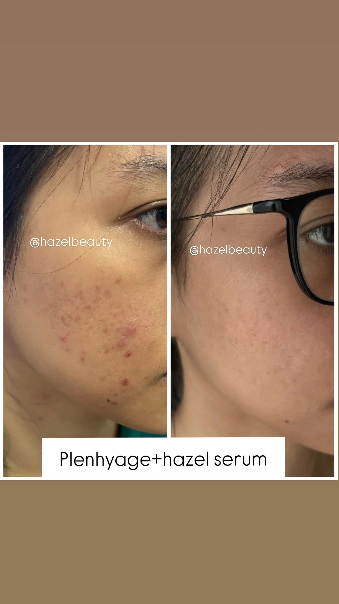 Skin Booster Treatment