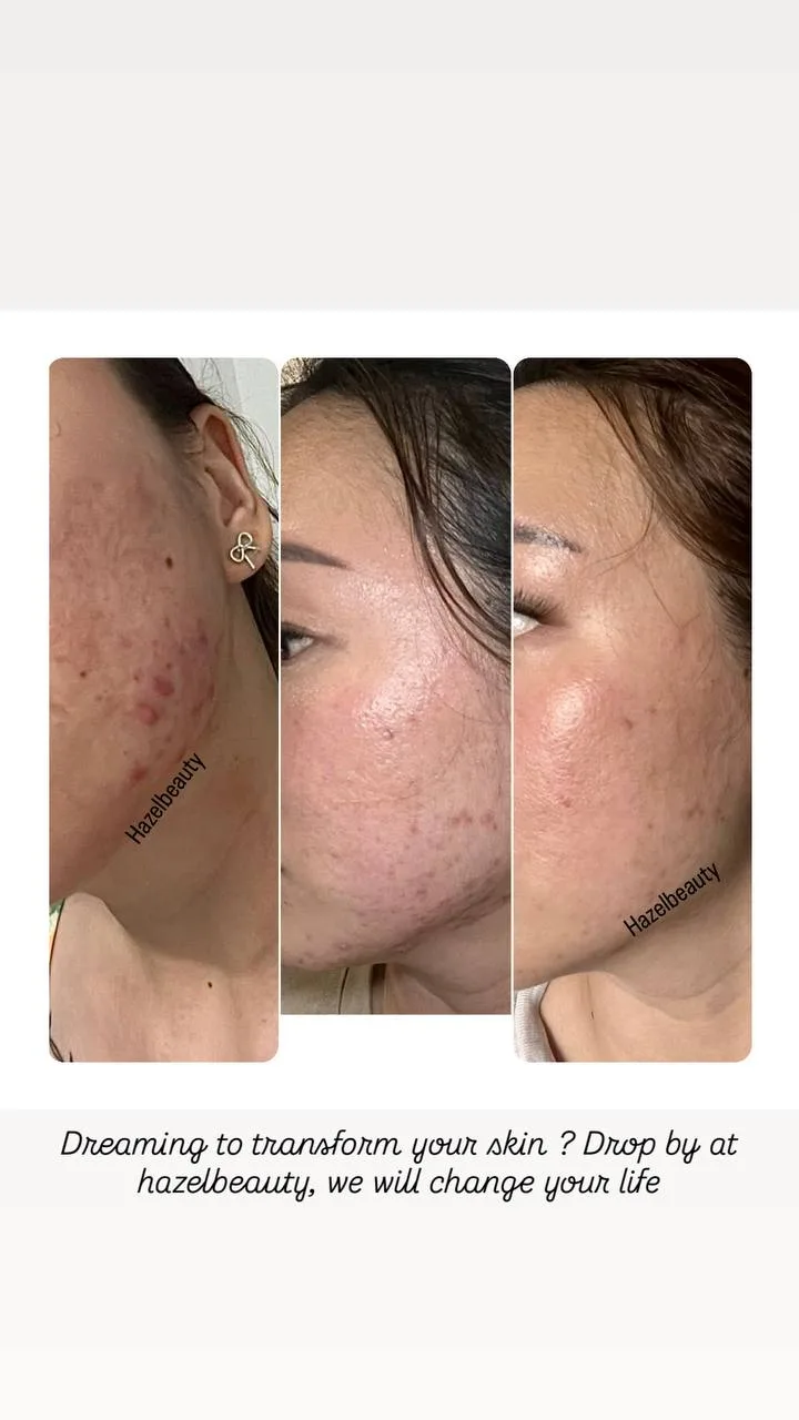Skin Booster Treatment
