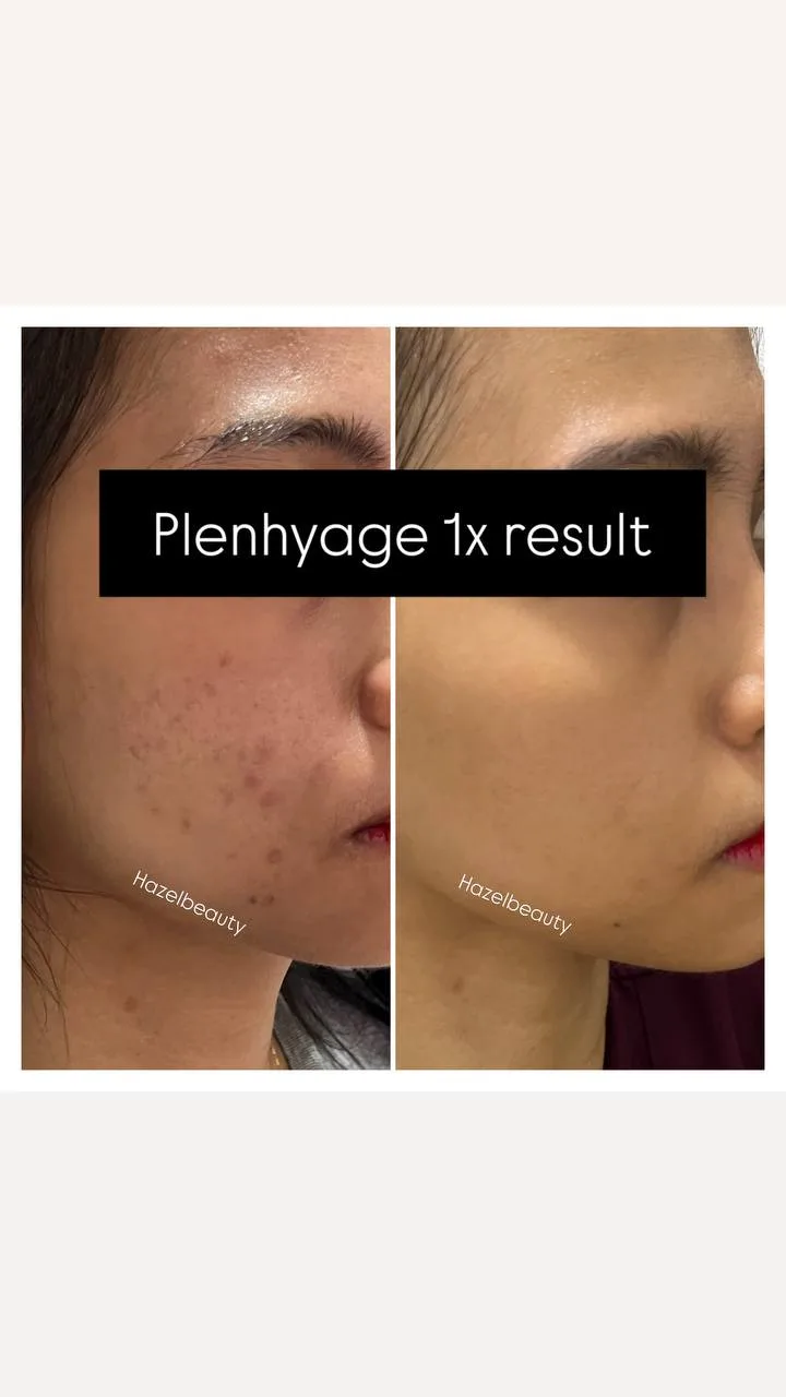 Skin Booster Treatment