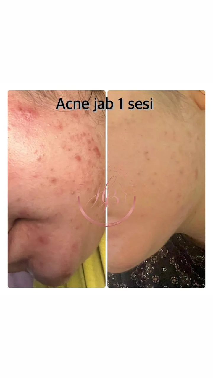 Skin Booster Treatment