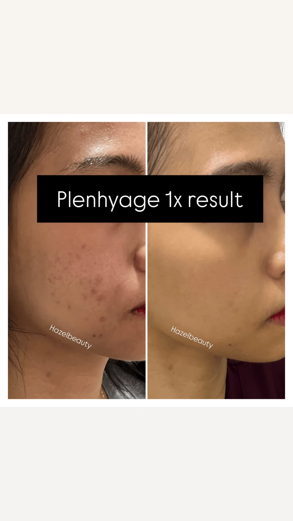 Face Treatment Before & After
