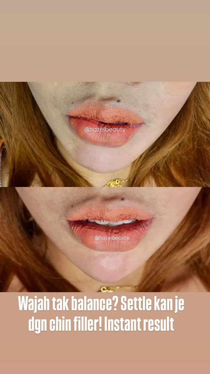 Threadlift, Fillers & Botox