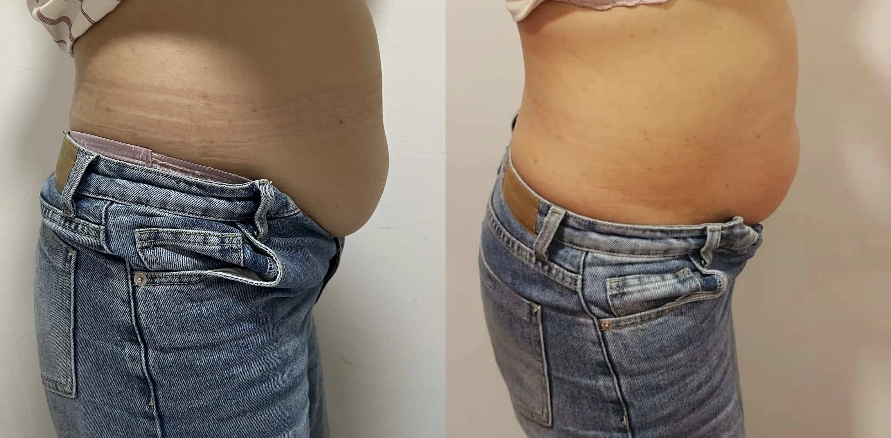 slimming / Lymphatic Massage