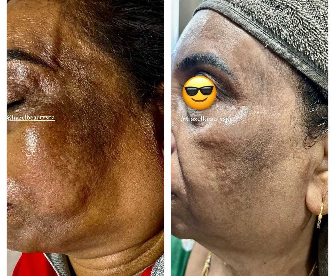 Skin Booster