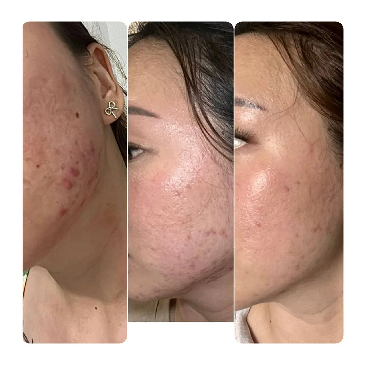 Skin Booster