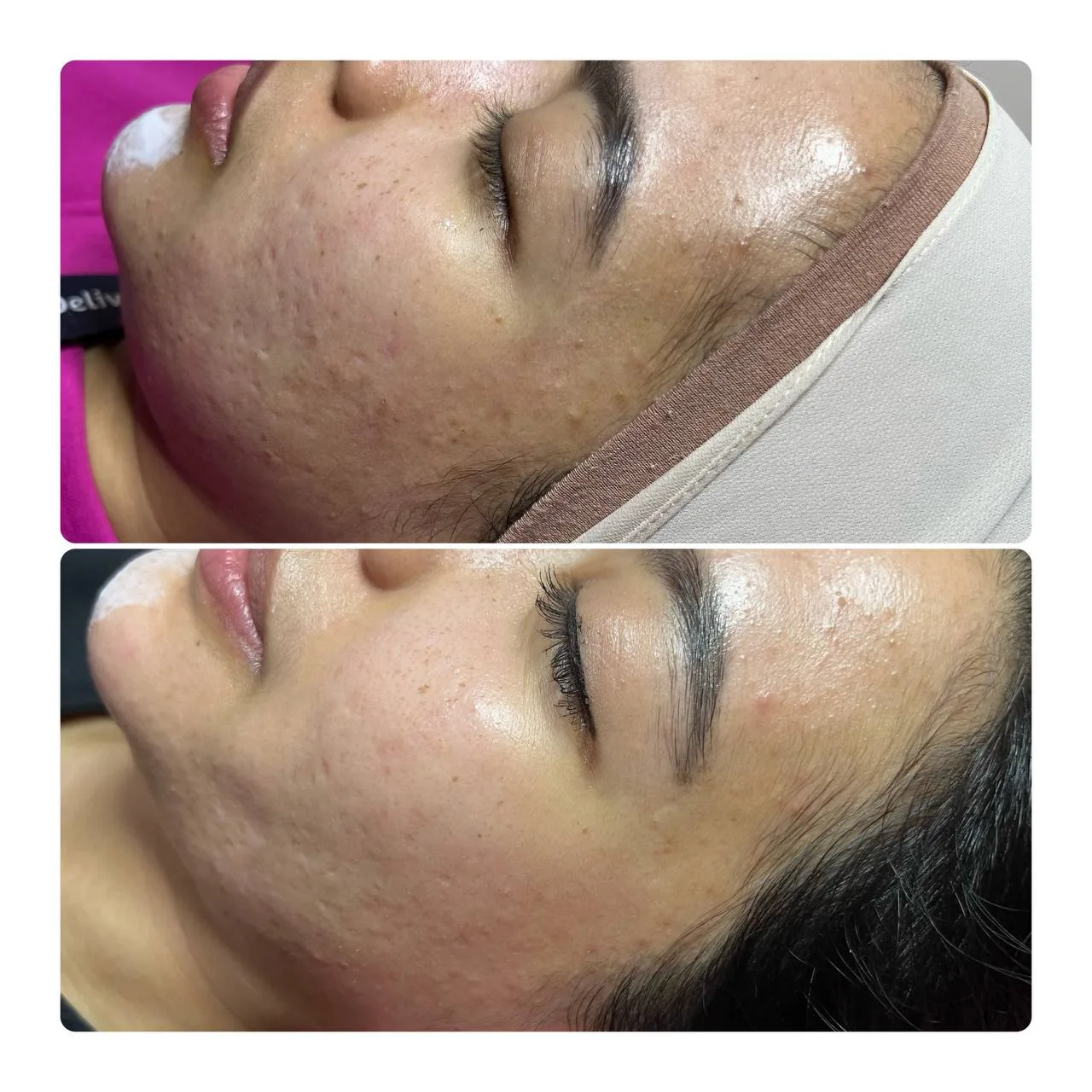 Skin Booster