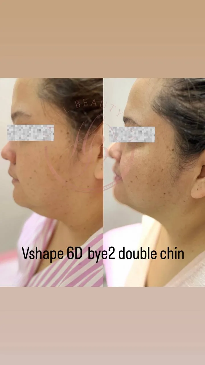 Botox & Fillers Treatment