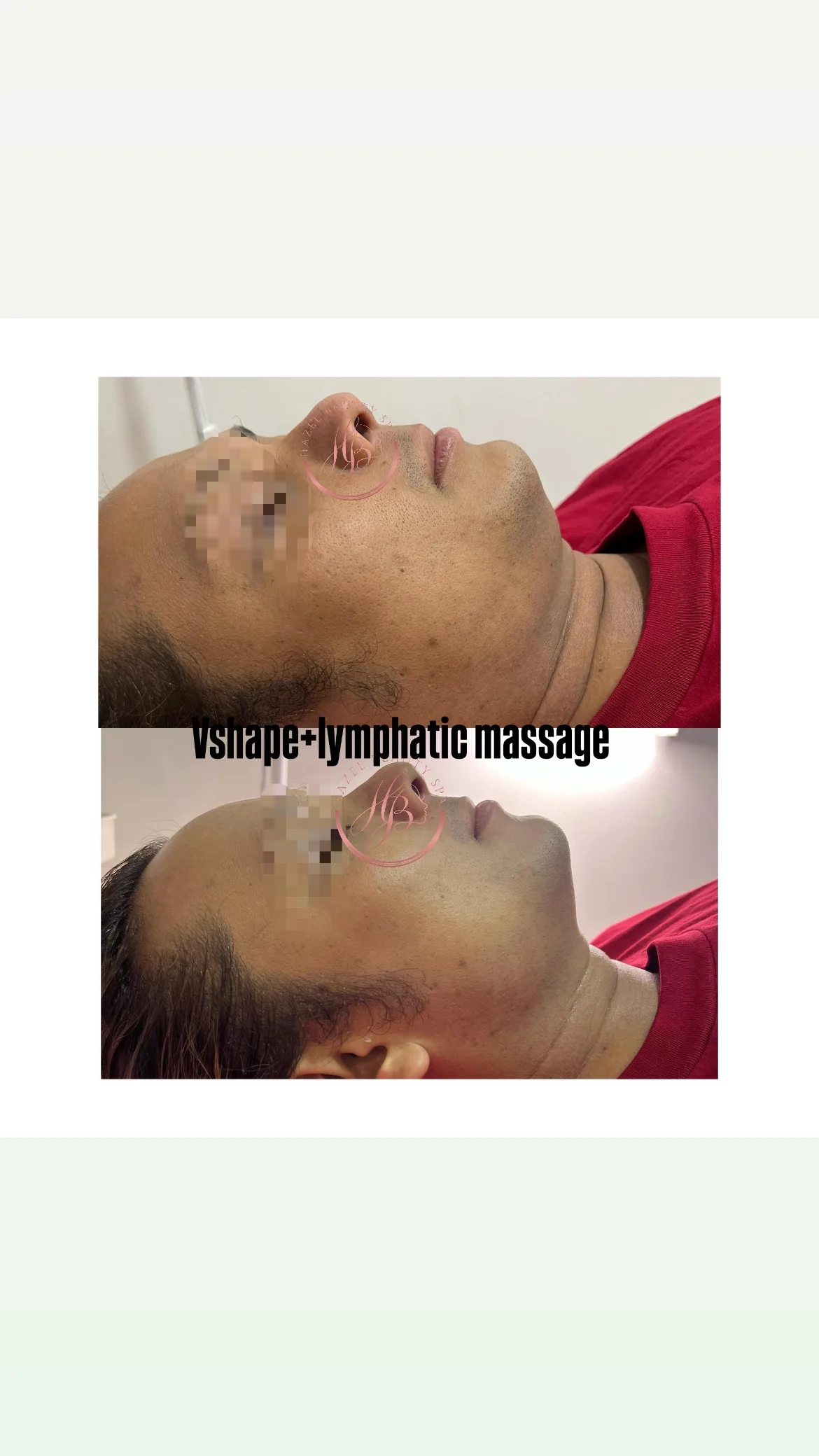 Botox & Fillers Treatment