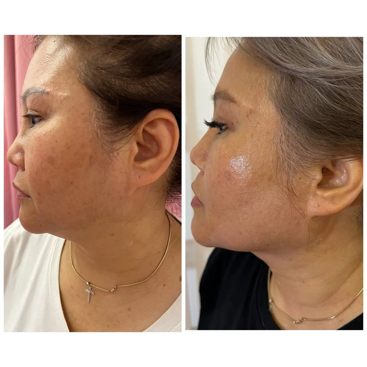 Botox & Fillers Treatment
