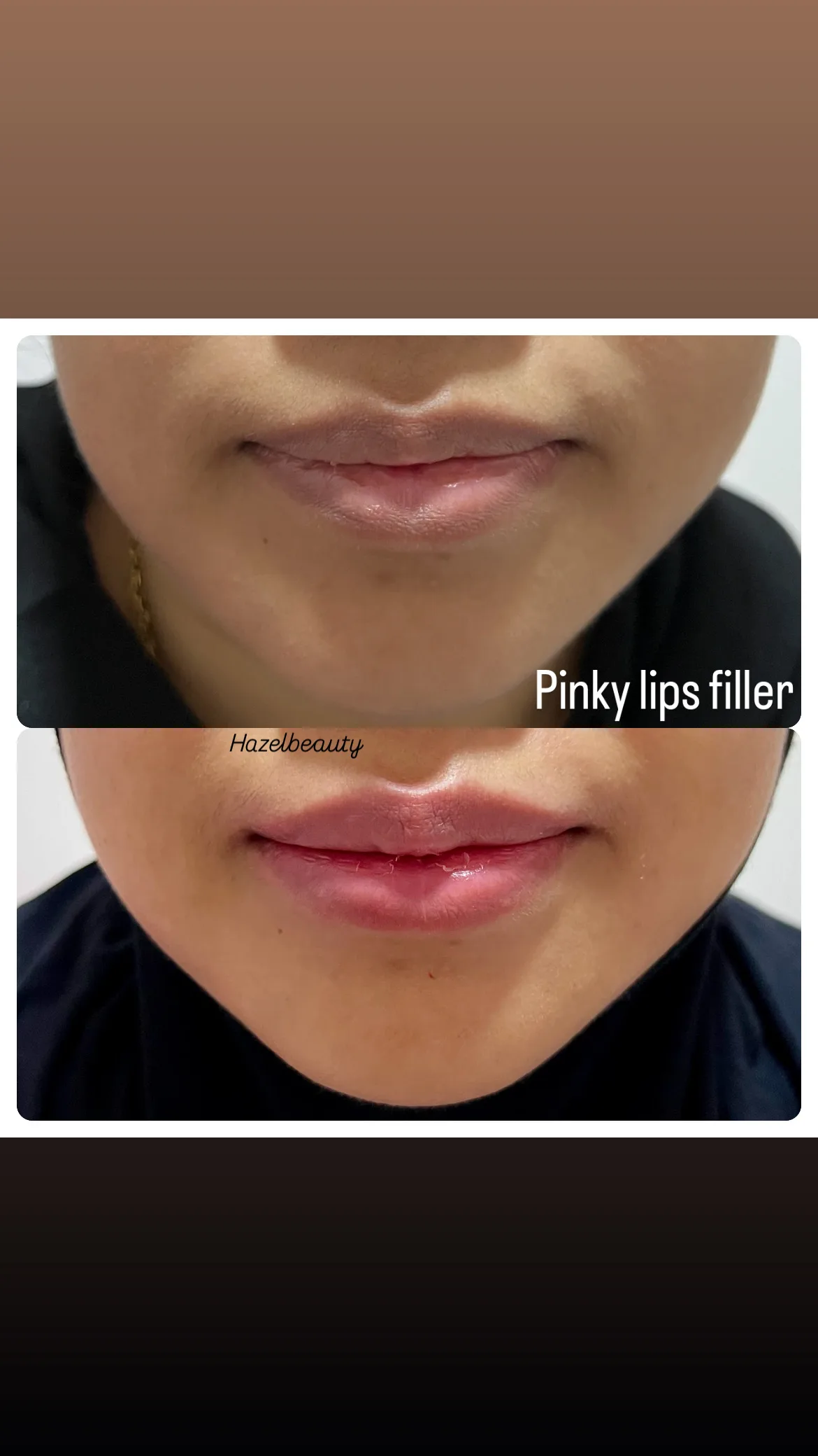 Botox & Fillers Treatment
