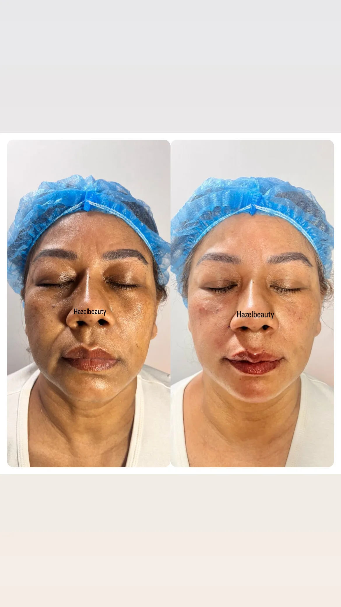 Botox & Fillers Treatment