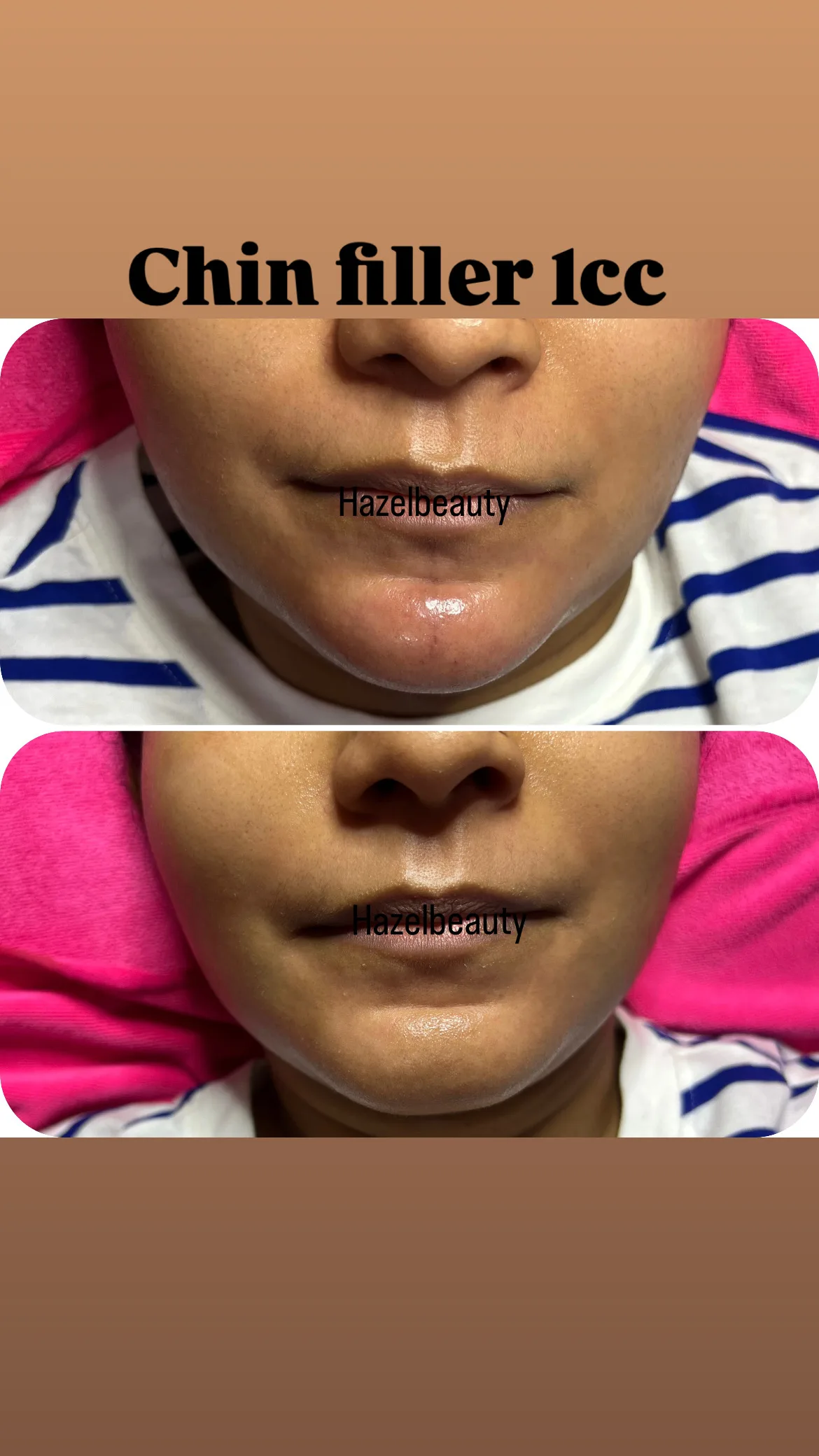 Botox & Fillers Treatment