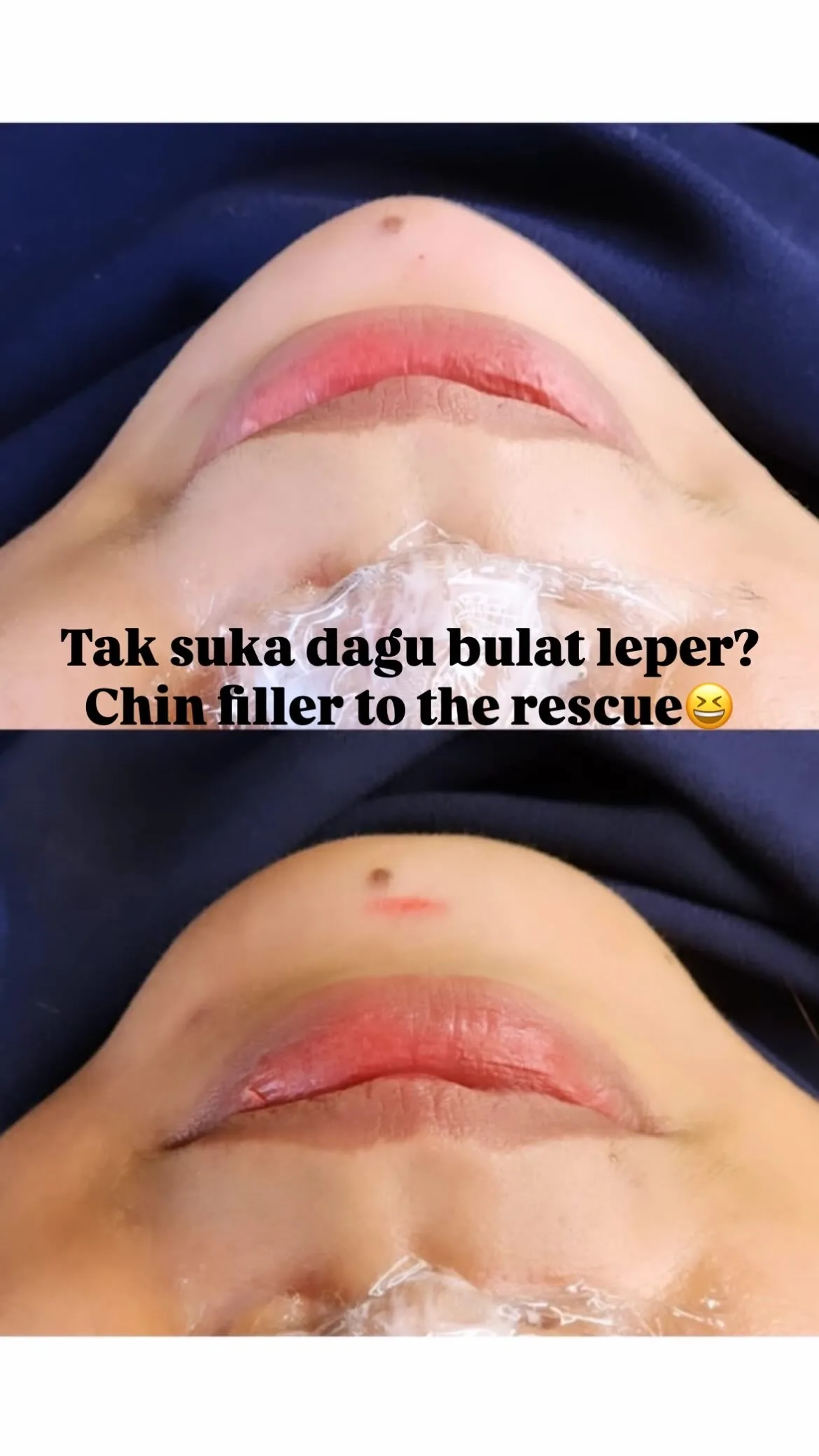 Botox & Fillers Treatment