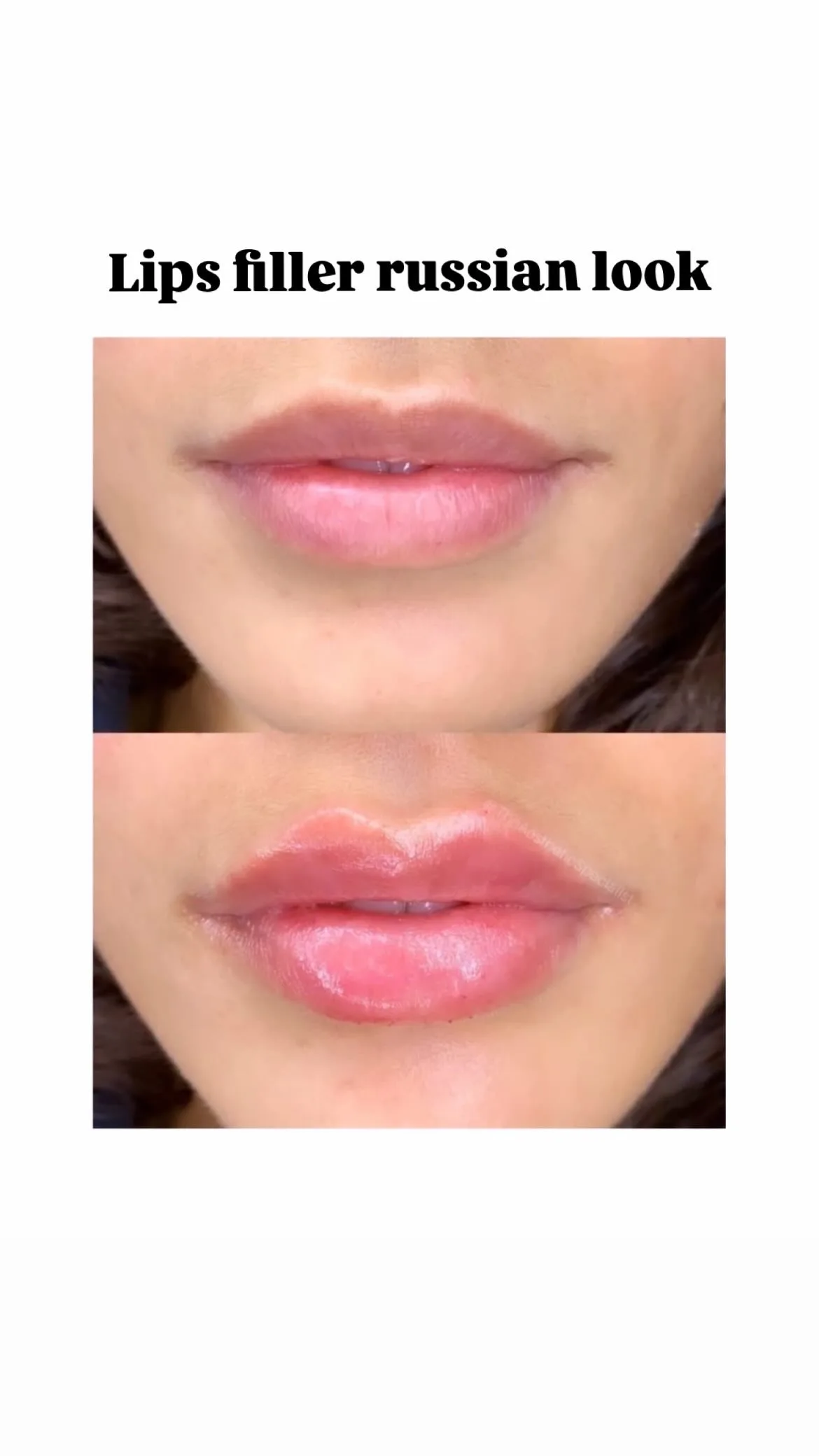 Botox & Fillers Treatment