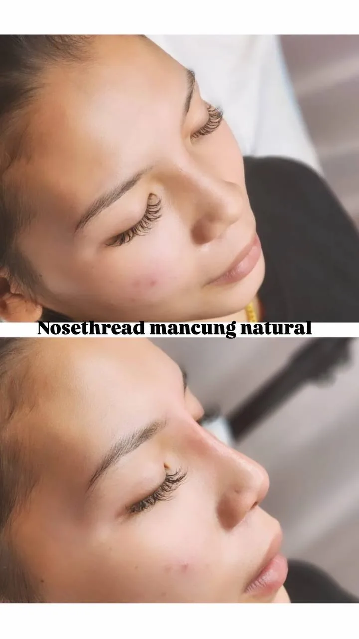Botox & Fillers Treatment